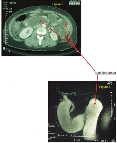 bowel-obstruction-03 bowel-obstruction-03