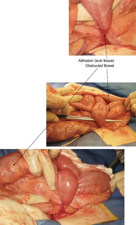 bowel-obstruction-05 bowel-obstruction-05
