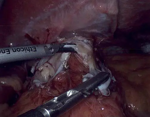 Adjustable Gastric Band Easily Reversible?
