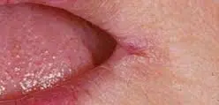 imagesL0PPKVTD Angular Cheilitis