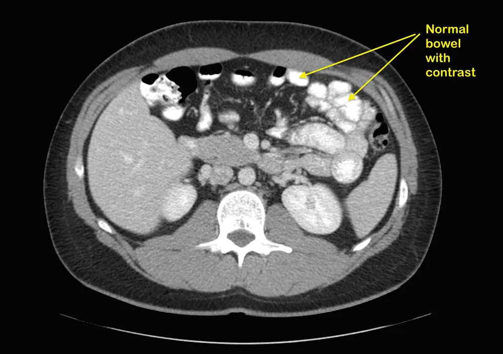 normal-CT Bowel Obstruction After DS