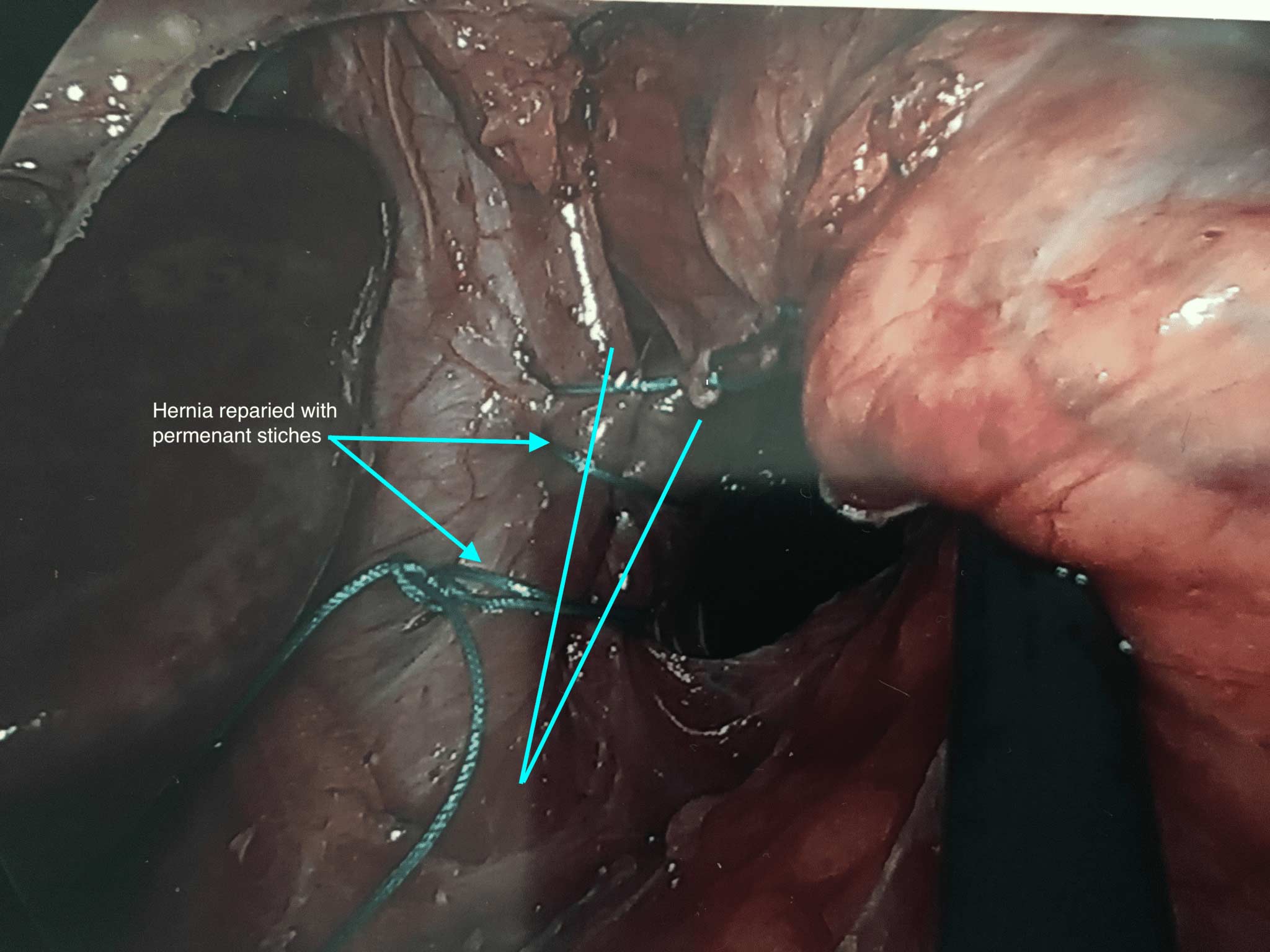 Surgical repair of Hiatal hernia causing reflux