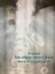 slipped-band-keshishian-225x300 slipped-band-keshishian