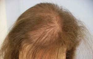 Hair loss pattern from telogen effluvium