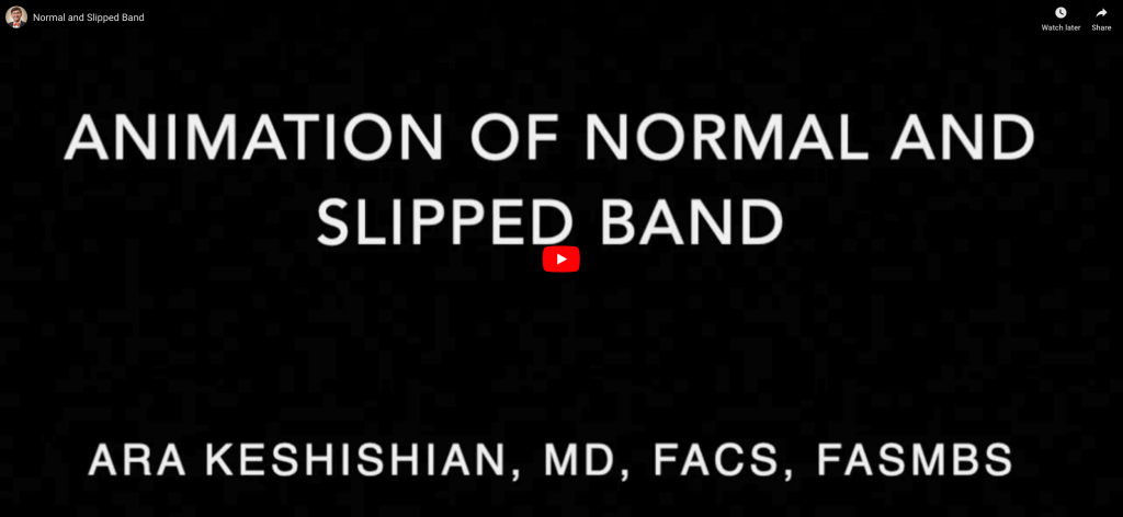 animation of normal and slipped band