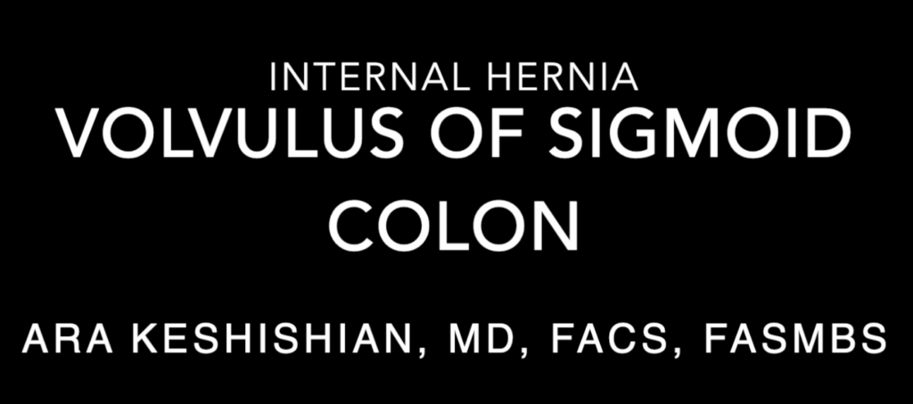 Colonic Volvulus
