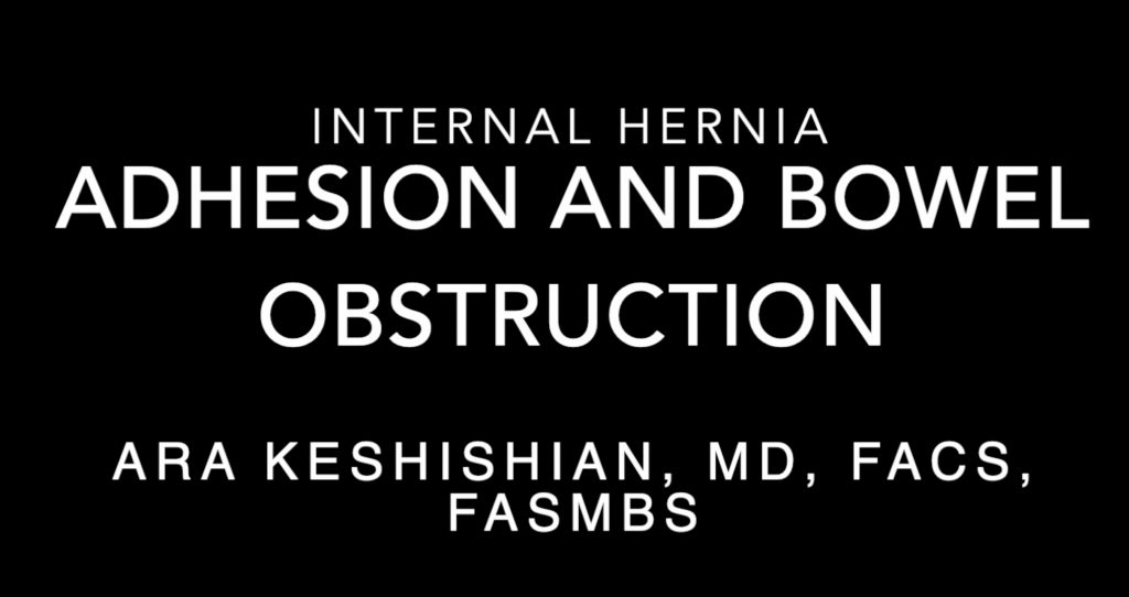 Adhesion and Bowel obstruction