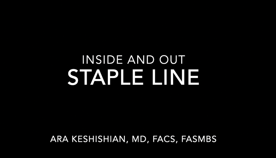 Sleeve Gastrectomy Staple Line - Inside And Out