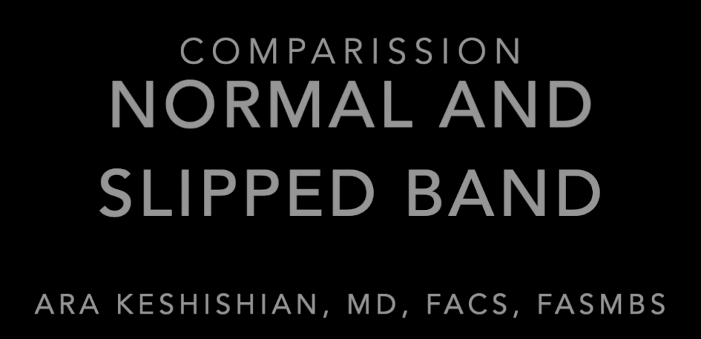 Normal And Slipped BandComparison