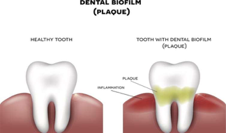 Dental Biofilm Dental biofilm