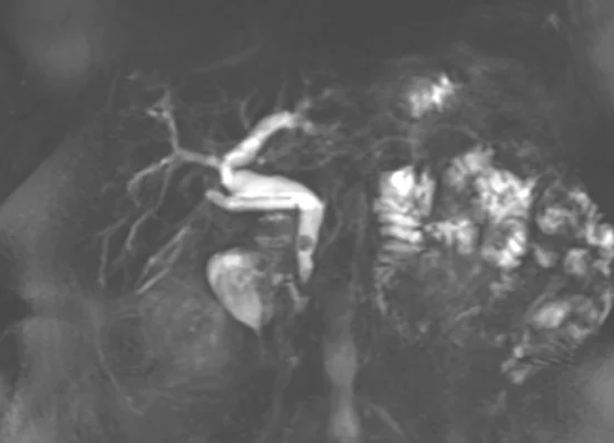 Common Bile Duct
