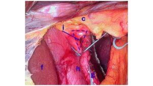 Surgery for Reflux